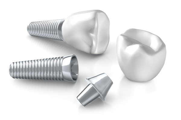 残っている歯を保護するのに適した治療法がインプラント