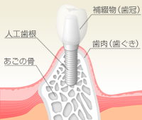 インプラントの仕組み